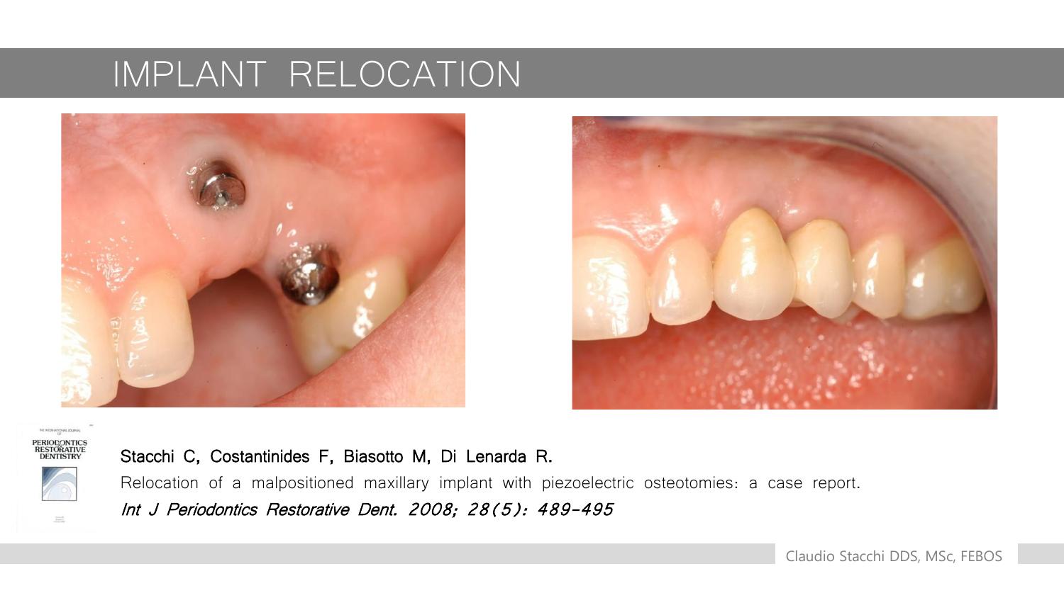 Mũi cắt siêu âm OT 12
