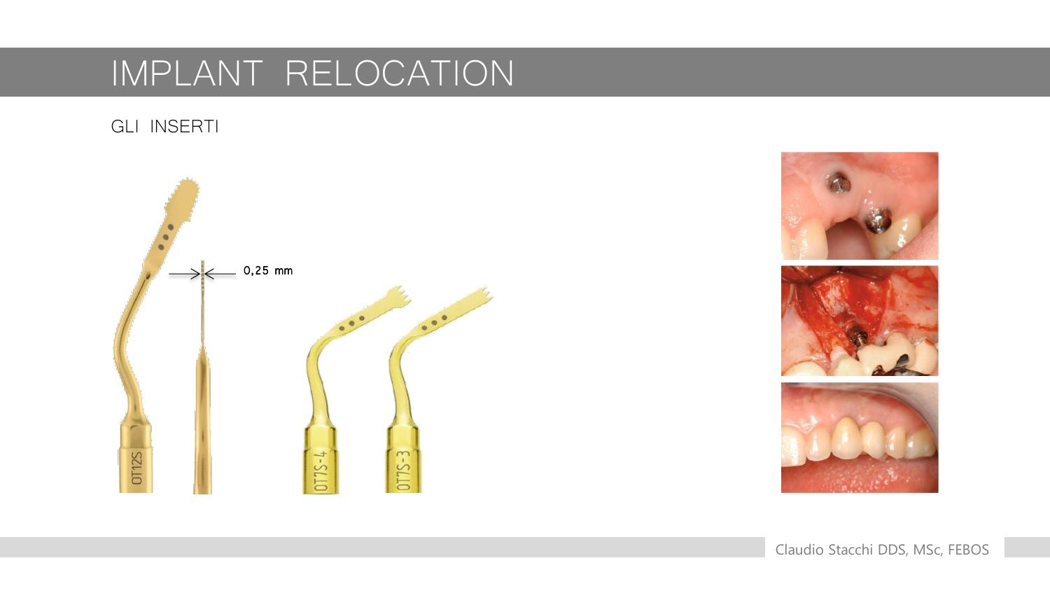 Kết quả phục hình cuối cùng