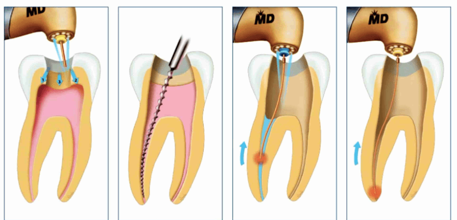 CƠ CHẾ HÀN KÍN HỆ THỐNG ỐNG TỦY: SO SÁNH KỸ THUẬT LÈN DỌC VÀ LÈN NGANG TRÊN RĂNG CHÂN CONG