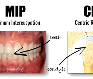 Tương quan tâm (Centric Relation) và Lồng múi tối đa (MIP): Khi nào cần đưa khớp cắn về CR trong phục hồi toàn hàm?