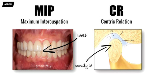 Tương quan tâm (Centric Relation) và Lồng múi tối đa (MIP): Khi nào cần đưa khớp cắn về CR trong phục hồi toàn hàm?