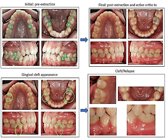 Tái phát chỉnh nha: Phân tích cơ chế sinh học và chiến lược duy trì hiện đại