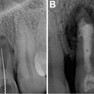 Ứng dụng vật liệu nội nha sinh học trong xử lý ngoại tiêu chóp và thủng chân răng