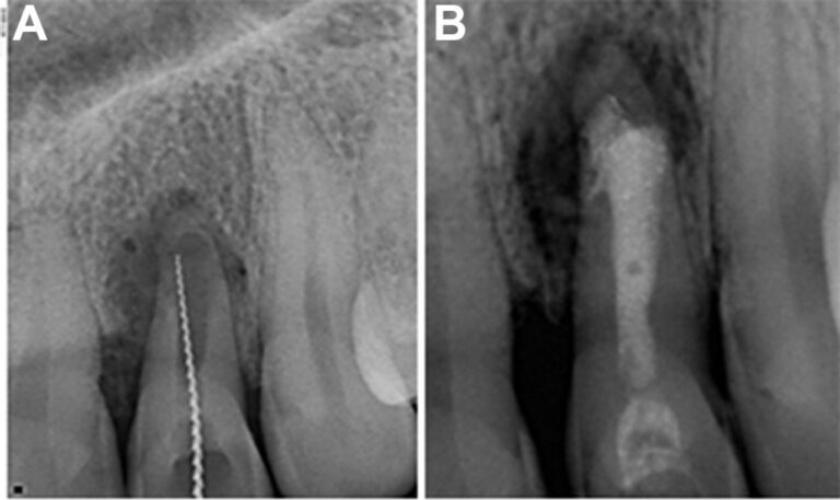 Ứng dụng vật liệu nội nha sinh học trong xử lý ngoại tiêu chóp và thủng chân răng