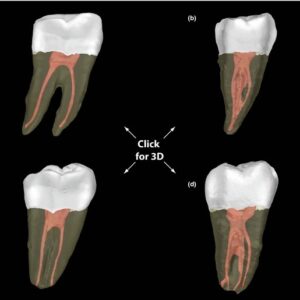 Ứng Dụng CBCT Trong Kế Hoạch Điều Trị Nội Nha Khó: Từ Định Vị Ống Tủy Vôi Hóa Đến Đánh Giá Tổn Thương Quanh Chóp Đa Chiều