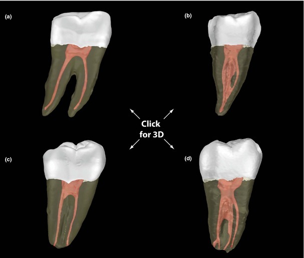 Ứng Dụng CBCT Trong Kế Hoạch Điều Trị Nội Nha Khó: Từ Định Vị Ống Tủy Vôi Hóa Đến Đánh Giá Tổn Thương Quanh Chóp Đa Chiều