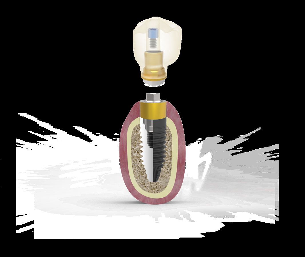 Sơ đồ BioBlock® — implant trong xương với transepithelial Ti Golden