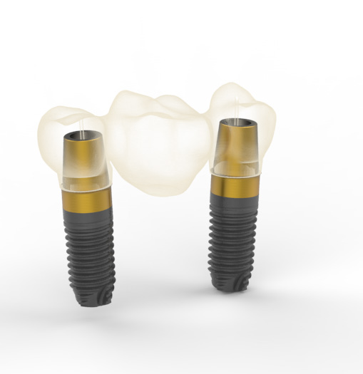 Multi-Im® BTI — bắc cầu nhiều implant với Ti Golden transepithelials