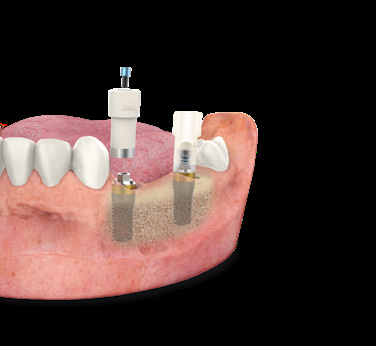Multi-Im® BTI in-mouth — phục hình nhiều implant trong miệng