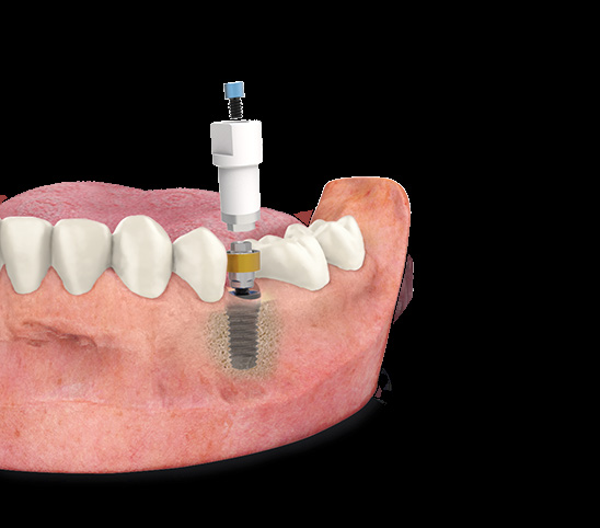 UNIT® transepithelial BTI — phục hình đơn lẻ screw-retained trong miệng