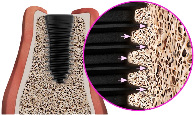 Mô phỏng tích hợp xương hoàn hảo tế bào xương bám sâu vào ren implant BTI