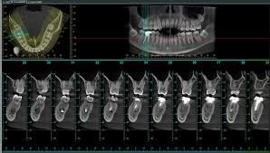 Nhận diện cấu trúc giải phẫu nguy hiểm trên CBCT trước can thiệp phẫu thuật