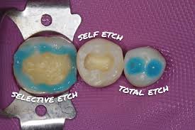 Cơ chế bám dính của các thế hệ chất gắn – Phân ích total-etch, self-etch & điều trị nhạy cảm ngà