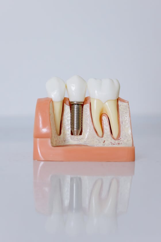 Cấu trúc implant nha khoa: fixture titanium, abutment, crown sứ