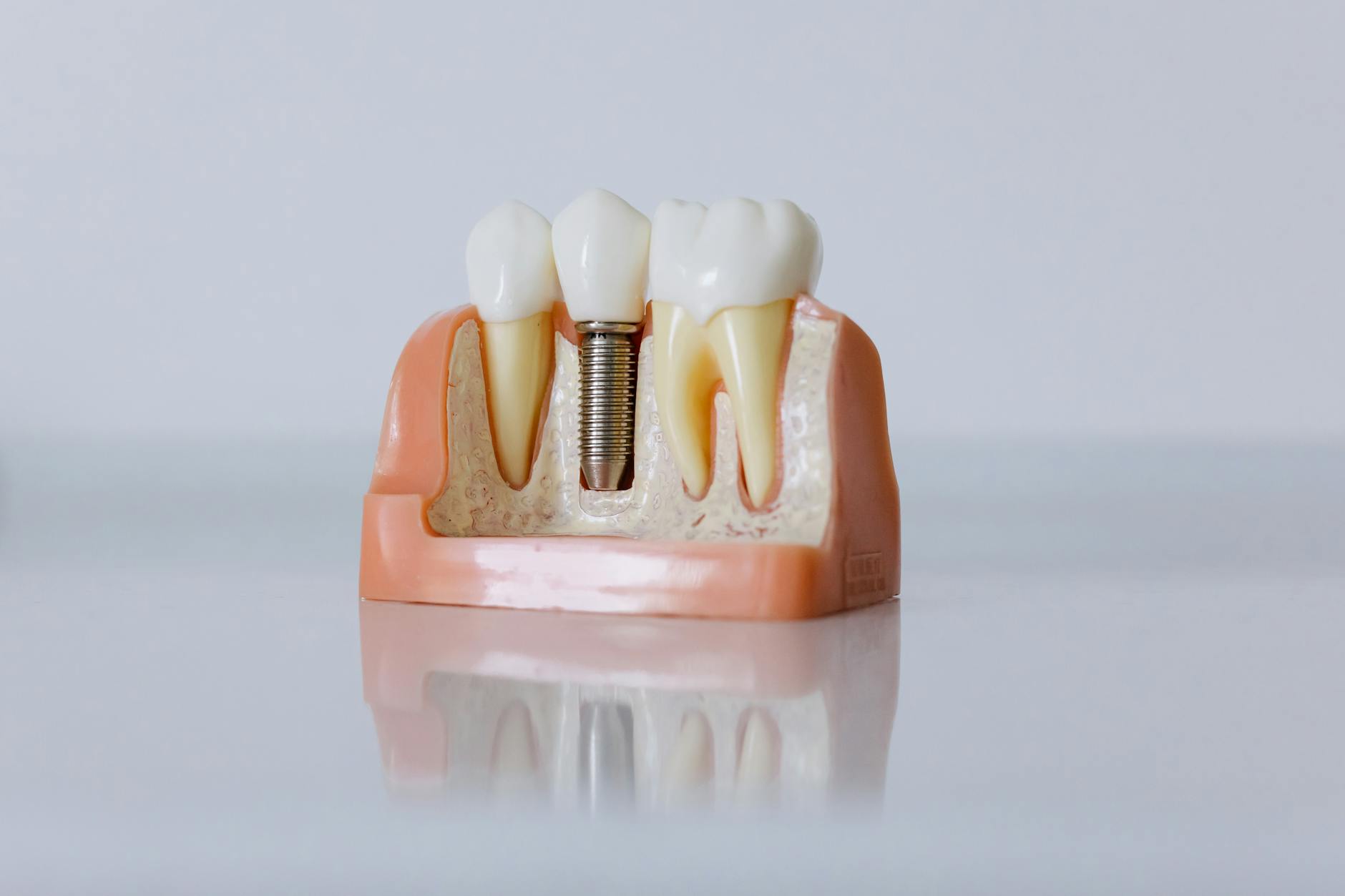 Cơ chế tích hợp xương implant nha khoa