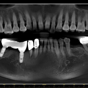 Lựa chọn implant tối ưu cho bệnh nhân bị loãng xương