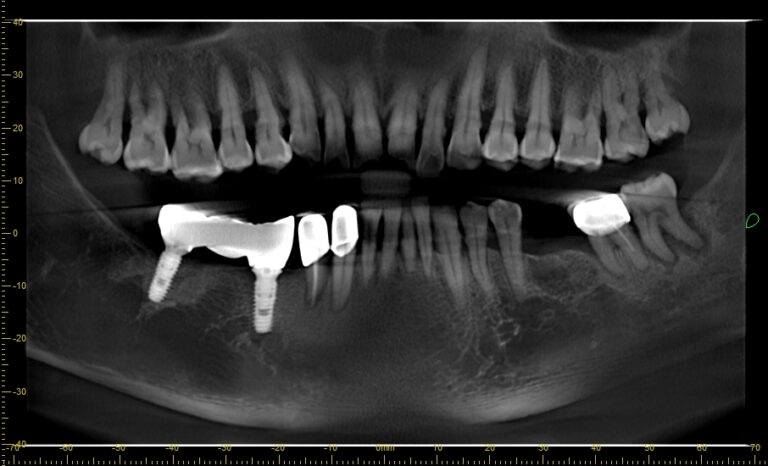 Lựa chọn implant tối ưu cho bệnh nhân bị loãng xương