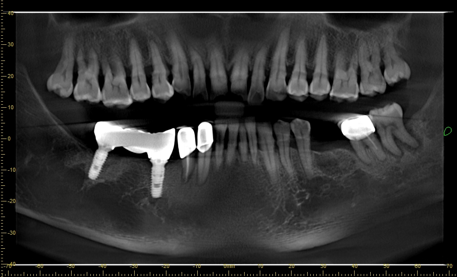 Lựa chọn implant tối ưu cho bệnh nhân bị loãng xương