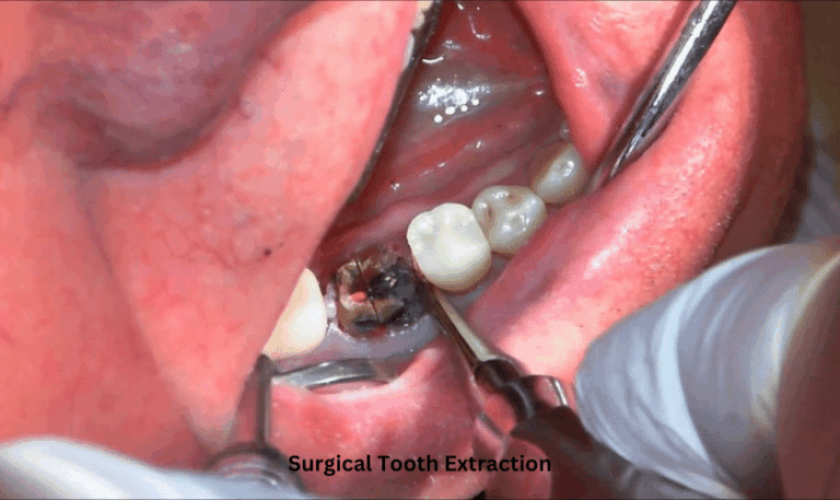 Máy phẫu thuật siêu âm Piezosurgery trong nhổ răng khôn mọc ngầm có thực sự ít sưng đau?