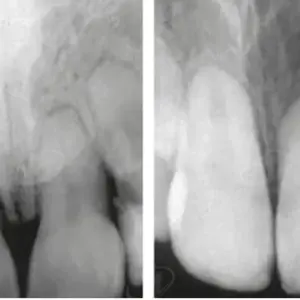 Cơ chế kháng khuẩn của Canxi Hydroxit: Ion hydroxit (OH⁻) phá hủy màng vi khuẩn trong ống tủy như thế nào?
