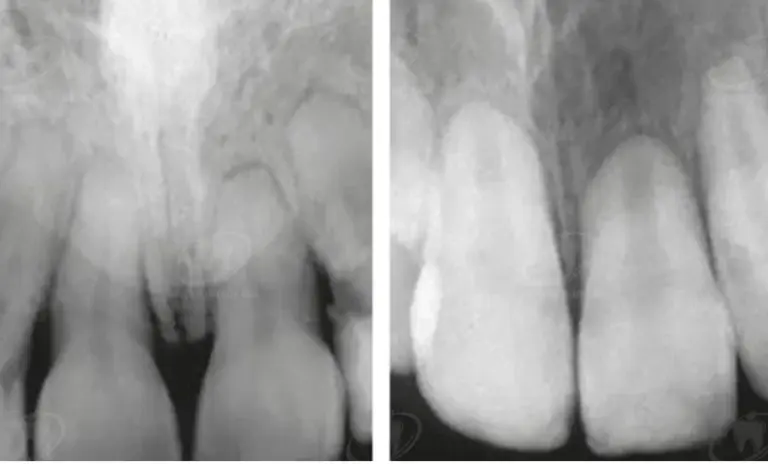 Cơ chế kháng khuẩn của Canxi Hydroxit: Ion hydroxit (OH⁻) phá hủy màng vi khuẩn trong ống tủy như thế nào?