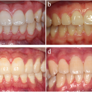 Cấy ghép implant vùng thẩm mỹ: Thiết kế trụ và công nghệ bề mặt