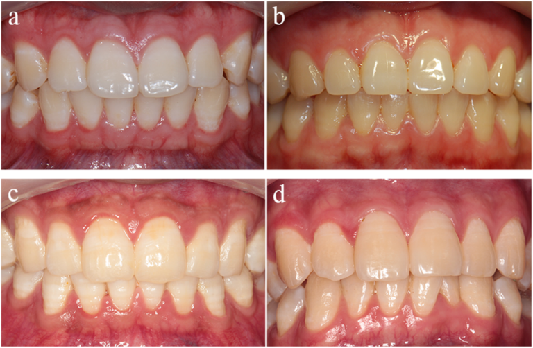 Cấy ghép implant vùng thẩm mỹ: Thiết kế trụ và công nghệ bề mặt
