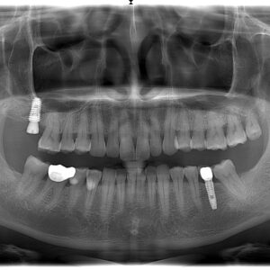 Cấy ghép implant trên nền xương thiếu hụt: Giải pháp nào?