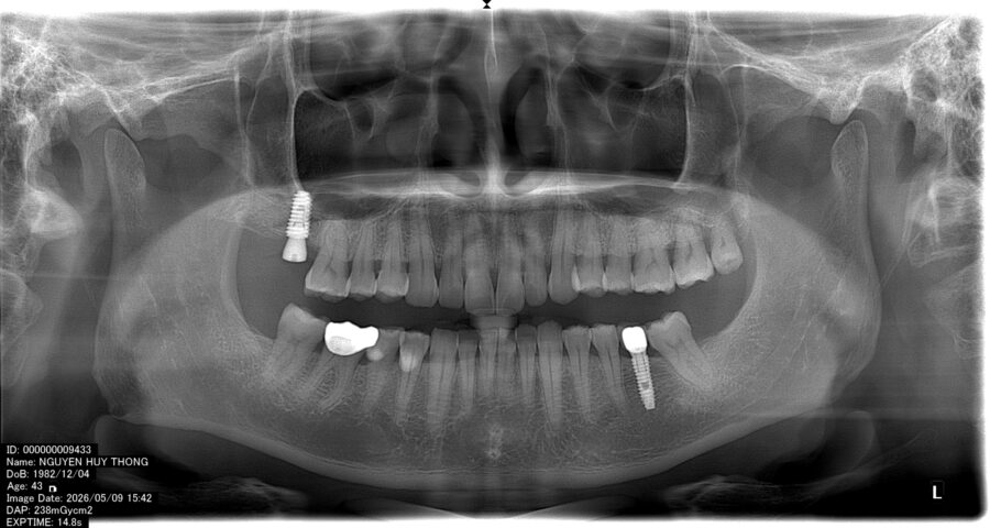 Cấy ghép implant trên nền xương thiếu hụt: Giải pháp nào?