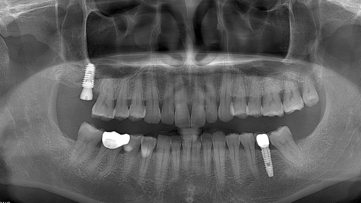 phim chụp CBCT bệnh nhân cấy ghép implant