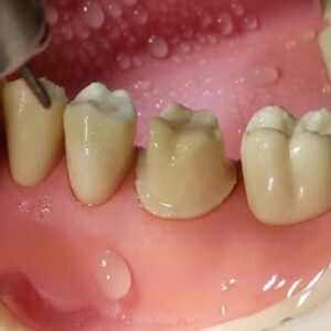 Tay khoan nha khoa: So sánh động cơ khí nén và động cơ điện