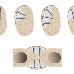 Vật liệu tái tạo xương tổng hợp Ethoss đột phá cấy implant