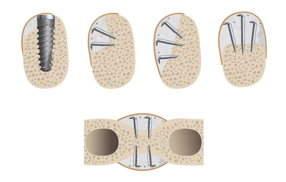 Vật liệu tái tạo xương tổng hợp Ethoss đột phá cấy implant
