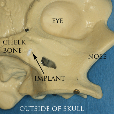 Minh họa cơ chế đặt implant xương gò má — Wikimedia Commons, CC BY-SA 3.0, Ian Furst (Coronation Dental Specialty Group)