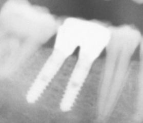 X-quang hai implant trụ tròn được cài vào xương hàm — minh họa neo chặn cơ học của implant nha khoa