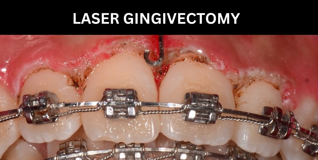 Minh họa quy trình cắt tạo hình nướu (gingivectomy) bằng laser diode nha khoa — một trong những ứng dụng phẫu thuật mô mềm phổ biến nhất của laser nha khoa.