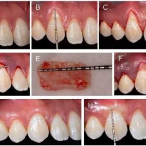 Điều trị tụt nướu bằng kỹ thuật ghép mô liên kết CTG