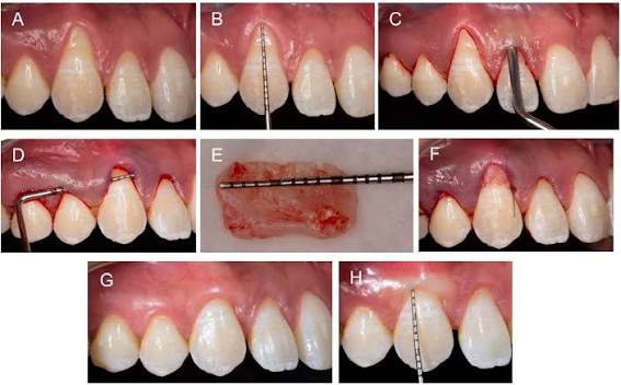 Điều trị tụt nướu bằng kỹ thuật ghép mô liên kết CTG