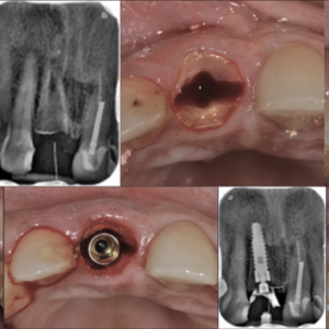 Kỹ thuật Socket Shield (Bảo tồn màng chân răng): Giải pháp đột phá trong cấy ghép Implant vùng thẩm mỹ