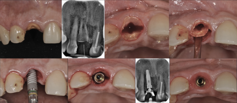 Kỹ thuật Socket Shield (Bảo tồn màng chân răng): Giải pháp đột phá trong cấy ghép Implant vùng thẩm mỹ