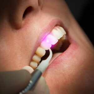 Laser nha khoa là gì? Hướng dẫn đầy đủ cho nha sĩ: bước sóng, ứng dụng và chi phí đầu tư