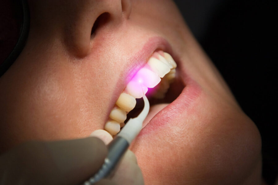 Laser nha khoa là gì? Hướng dẫn đầy đủ cho nha sĩ: bước sóng, ứng dụng và chi phí đầu tư