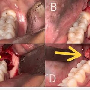 So sánh nhổ răng khôn bằng máy siêu âm và tay khoan truyền thống