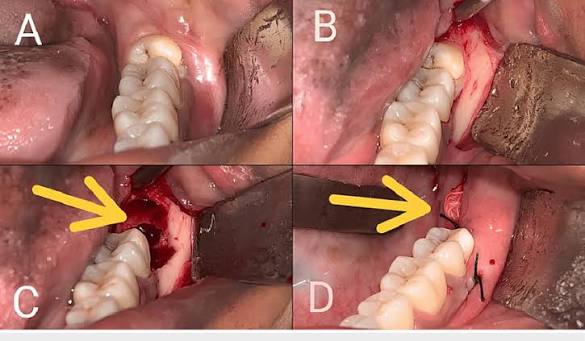 So sánh nhổ răng khôn bằng máy siêu âm và tay khoan truyền thống
