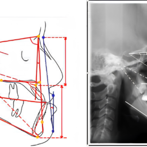 Giải mã tầm quan trọng của phân tích phim Cephalometric trong đánh giá và điều trị sai khớp cắn hạng III