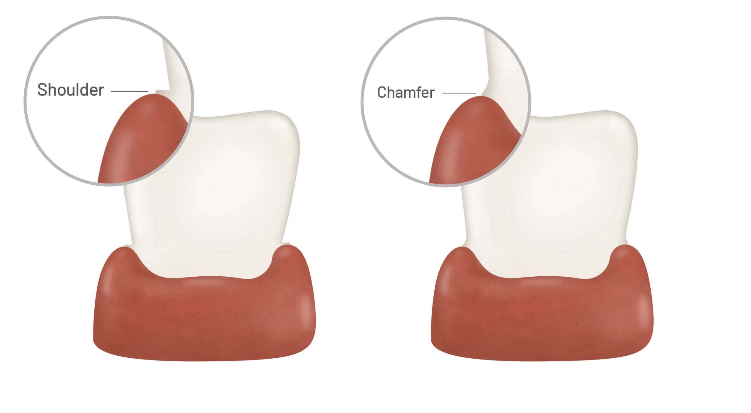 Infographic so sánh trực quan giữa đường hoàn tất Chamfer (bờ cong, góc 90–135 độ) và Shoulder (bờ vai, góc vuông 90 độ), nêu rõ sự khác biệt về độ dày vật liệu, khả năng bảo tồn mô răng và mức độ phù hợp với từng loại vật liệu phục hình như Zirconia, Lithium Disilicate (e.max) và sứ kim loại.